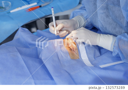 Gloved surgeon marks the eyelid before blepharoplasty under sterile drapes, preparing for cosmetic or reconstructive eye surgery 132573289