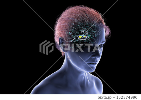 Human brain with degenerated substantia nigra in Parkinson's disease, 3D illustration 132574990