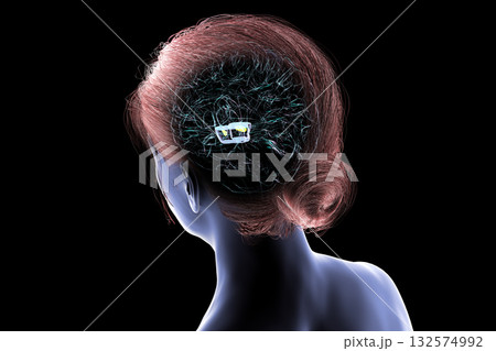 Human brain with degenerated substantia nigra in Parkinson's disease, 3D illustration 132574992