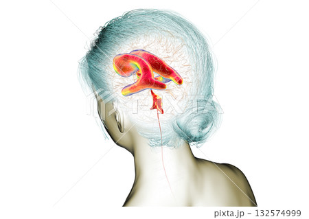 Normal pressure hydrocephalus, 3D illustration 132574999