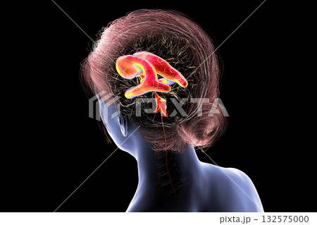 Normal pressure hydrocephalus, 3D illustration 132575000