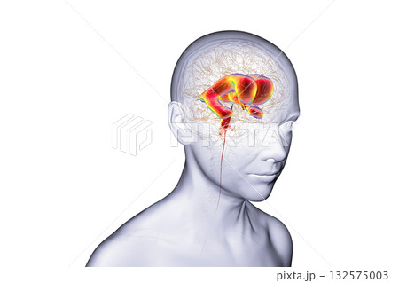 Normal pressure hydrocephalus, 3D illustration 132575003