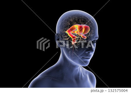 Normal pressure hydrocephalus, 3D illustration 132575004