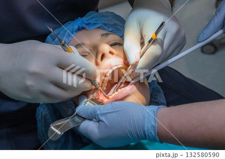 Doctor works on patient widely open mouth using suction tool during procedure. Woman jaw fixed stable allowing clear access for dental treatment. High quality photo 132580590