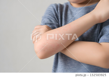 Arm pain shows red rash on skin. 132583925