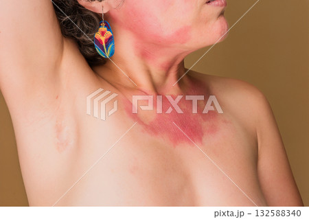 Woman showing red skin rash from immune deficiency 132588340