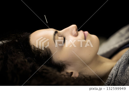 美容鍼を受ける女性のクローズアップ。顔ツボと鍼治療で肌改善を目指すリラックスシーン 132599949