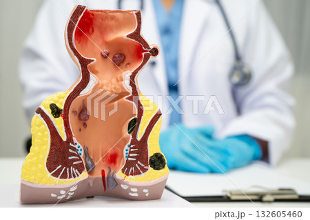 Asian doctor with rectum and hemorrhoid human anatomy model at hospital, inflamed vascular structure. Asian doctor with rectum and hemorrhoid human anatomy model at hospital, inflamed vascular structure. 132605460