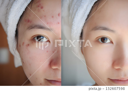 肌改善のビフォーアフター。ニキビ跡ケアで美肌になった若い女性 肌改善のビフォーアフター。ニキビ跡ケアで美肌になった若い女性 132607598