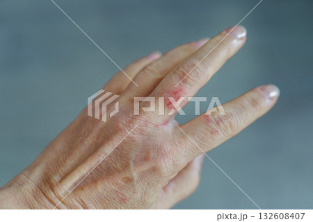 woman hand with scratched finger, wound 132608407