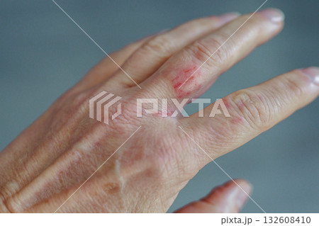 woman hand with scratched finger, wound 132608410