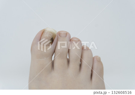 親指の爪下血腫 親指の爪下血腫 132608516