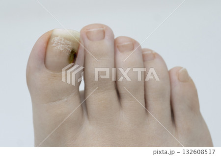 親指の爪下血腫 親指の爪下血腫 132608517