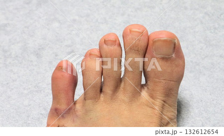 怪我で腫れた日本人男性の足 132612654