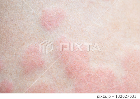 Skin allergy rash dermatitis texture close up 132627633