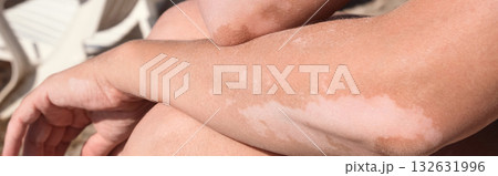 Skin with vitiligo. Female legs and arms with autoimmune disease. pigmentation 132631996
