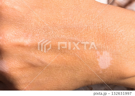 Skin with vitiligo. Female legs and arms with autoimmune disease. pigmentation 132631997
