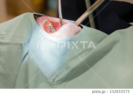 医療　歯科医　施術イメージ 132633573