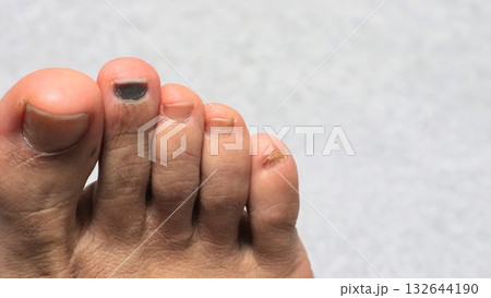 爪を怪我した足のクローズアップ 132644190