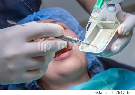 Dental team applies bone graft material into patient mouth during procedure. Instruments and suction tool assist in precise placement of material Dental team applies bone graft material into patient mouth during procedure. Instruments and suction tool assist in precise placement of material 132647160