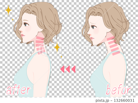 一位女性調整直頸前後的比較照片 一位女性調整直頸前後的比較照片 132660031