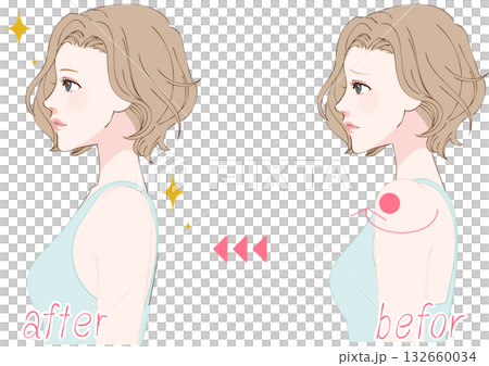 Before and after profile of a woman adjusting her rounded shoulders 132660034