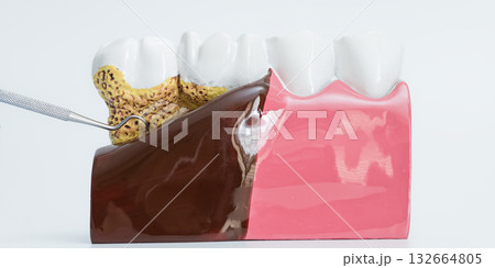 Periodontal Disease Model with Dental Tool Pointing 132664805