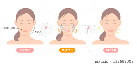 糸リフトの施術内容と効果 ベクターイラスト 132692308