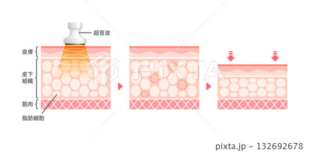 キャビテーションの仕組みと効果　皮膚断面図イラスト / 美容・ダイエット 132692678