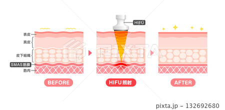 HIFU(ハイフ)の仕組みと効果　皮膚断面図イラスト / 美容・ダイエット 132692680