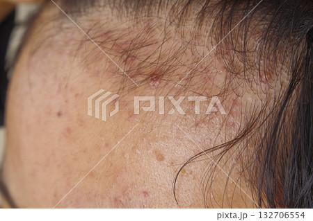 ニキビや吹き出物に悩む子供の肌 132706554
