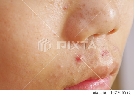 ニキビや吹き出物に悩む子供の肌 ニキビや吹き出物に悩む子供の肌 132706557
