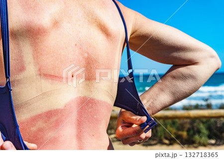 Woman back skin hurt from sun burn. Woman back skin hurt from sun burn. 132718365