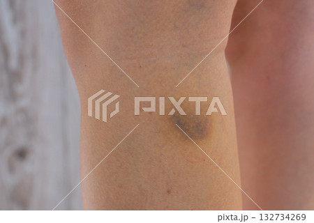 Unrecognizable woman with bruise on her leg. Close up of stain bruise wound on leg. Healing injury hematoma blood consequences of sport activity trauma. Extravasation 132734269