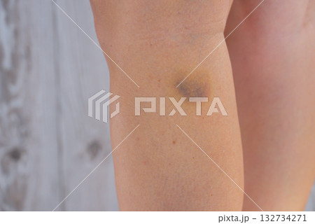 Unrecognizable woman with bruise on her leg. Close up of stain bruise wound on leg. Healing injury hematoma blood consequences of sport activity trauma. Extravasation 132734271