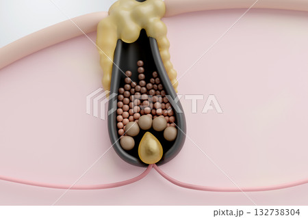 皮脂で毛包が詰まり、薄毛や抜け毛の原因となるCGイラスト 132738304