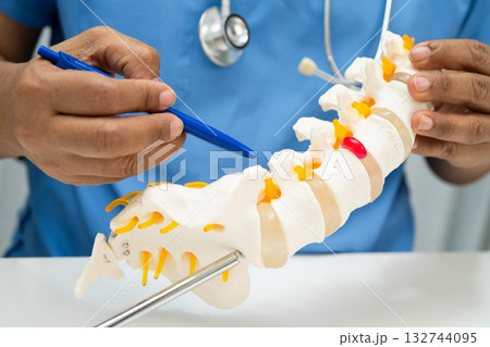 Asian doctor holding spinal nerve and bone model, Lumbar spine displaced herniated disc fragment for treatment medical in the orthopedic department. Asian doctor holding spinal nerve and bone model, Lumbar spine displaced herniated disc fragment for treatment medical in the orthopedic department. 132744095