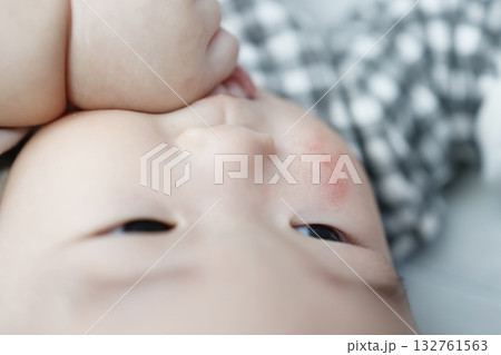 ほほに引っかき傷のある生後8ヶ月の女の子の赤ちゃん。 ほほに引っかき傷のある生後8ヶ月の女の子の赤ちゃん。 132761563