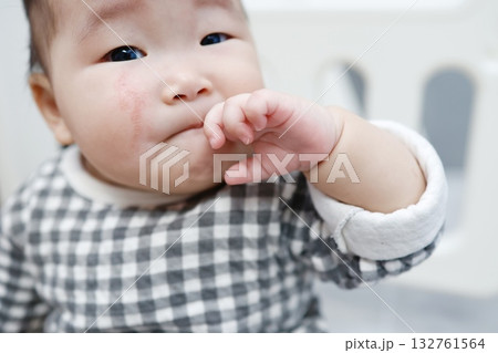 ほほに引っかき傷のある生後8ヶ月の女の子の赤ちゃん。 132761564