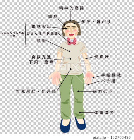 Graves' disease (hyperthyroidism) illustration (female) based on systemic symptoms Graves' disease (hyperthyroidism) illustration (female) based on systemic symptoms 132763459