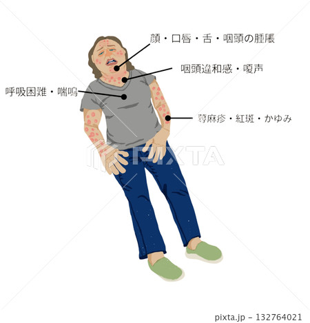アナフィラキシーショックの症状イラスト(看護・医療教材) アナフィラキシーショックの症状イラスト(看護・医療教材) 132764021