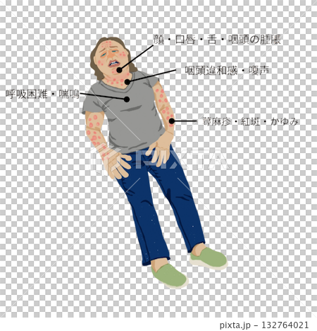 アナフィラキシーショックの症状イラスト(看護・医療教材) アナフィラキシーショックの症状イラスト(看護・医療教材) 132764021