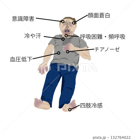 心原性ショックの症状イラスト（看護・医療教材） 132764022