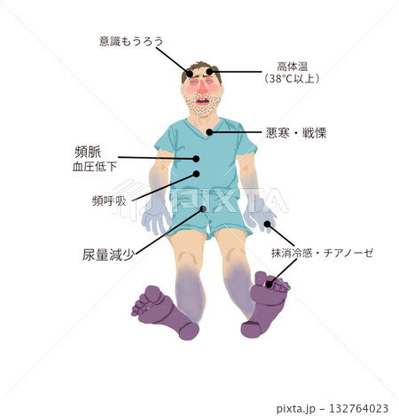 敗血症性ショックの症状イラスト(看護・医療教材) 敗血症性ショックの症状イラスト(看護・医療教材) 132764023