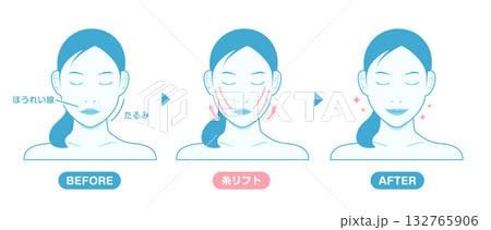 糸リフトの施術内容と効果 ベクターイラスト 糸リフトの施術内容と効果 ベクターイラスト 132765906