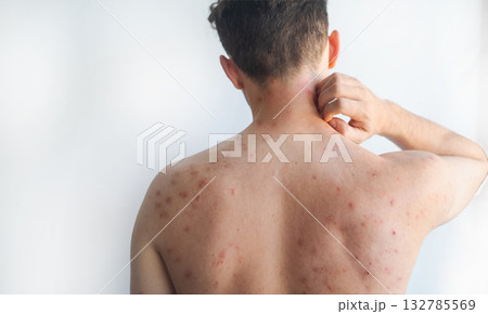 Red inflamed itchy streaks on a mans torso showing viral skin infection affecting nerves in video. Red inflamed itchy streaks on a mans torso showing viral skin infection affecting nerves in video. 132785569