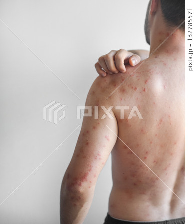 Red itchy scaly patches on a mans chest back and shoulders showing chronic skin irritation and discomfort in video. Red itchy scaly patches on a mans chest back and shoulders showing chronic skin irritation and discomfort in video. 132785571