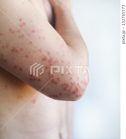 Widespread red itchy patches on a mans skin with dryness and scaling showing flare up of chronic eczema in video. 132785573
