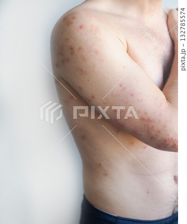 Man with pink fine rash over body experiencing mild itching and discomfort showing gentle viral skin infection in video. 132785574