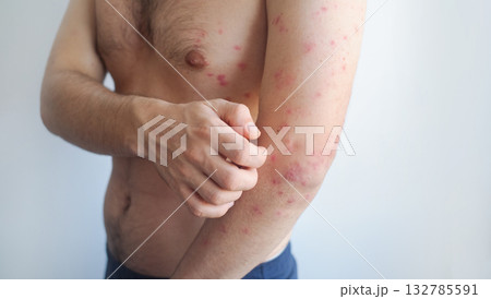 Pink fine rash evenly covers a mans body showing mild viral symptoms with minimal inflammation and irritation. 132785591